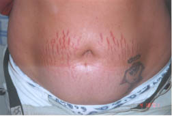 before treatment of stretch marks