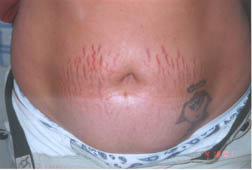 before treatment of stretch marks